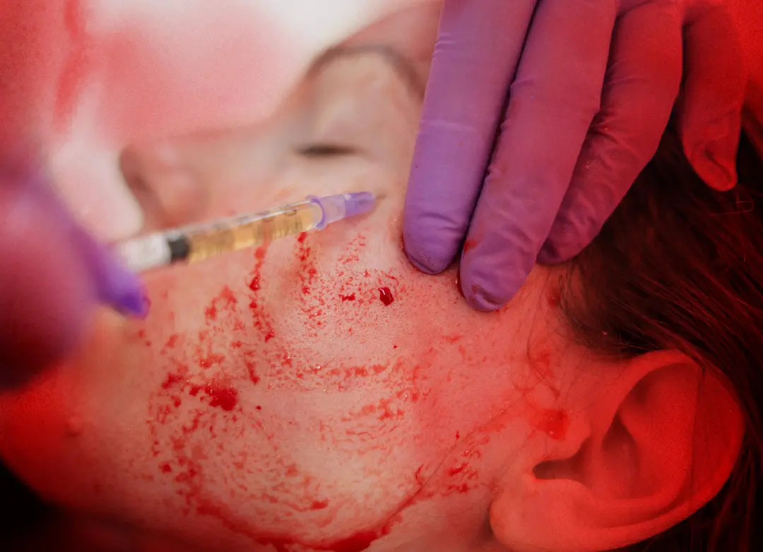 PRP Facial