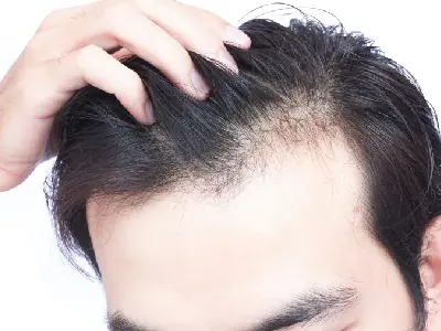 PRP hairloss treatment